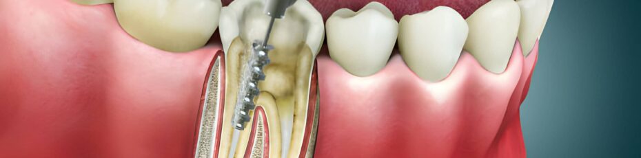 When Do You Need a Root Canal? "Signs and Symptoms"