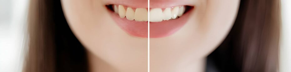 How Can I Permanently Whiten My Teeth?