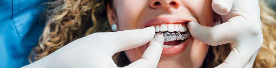 Invisalign-SA-1200x800